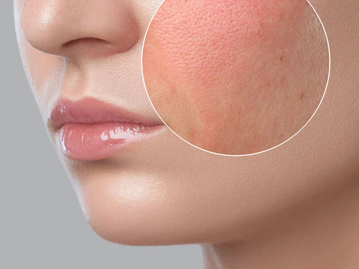 E‑Derm Gel in Pakistan – Soothe, Hydrate & Heal Dry Irritated Skin Naturally