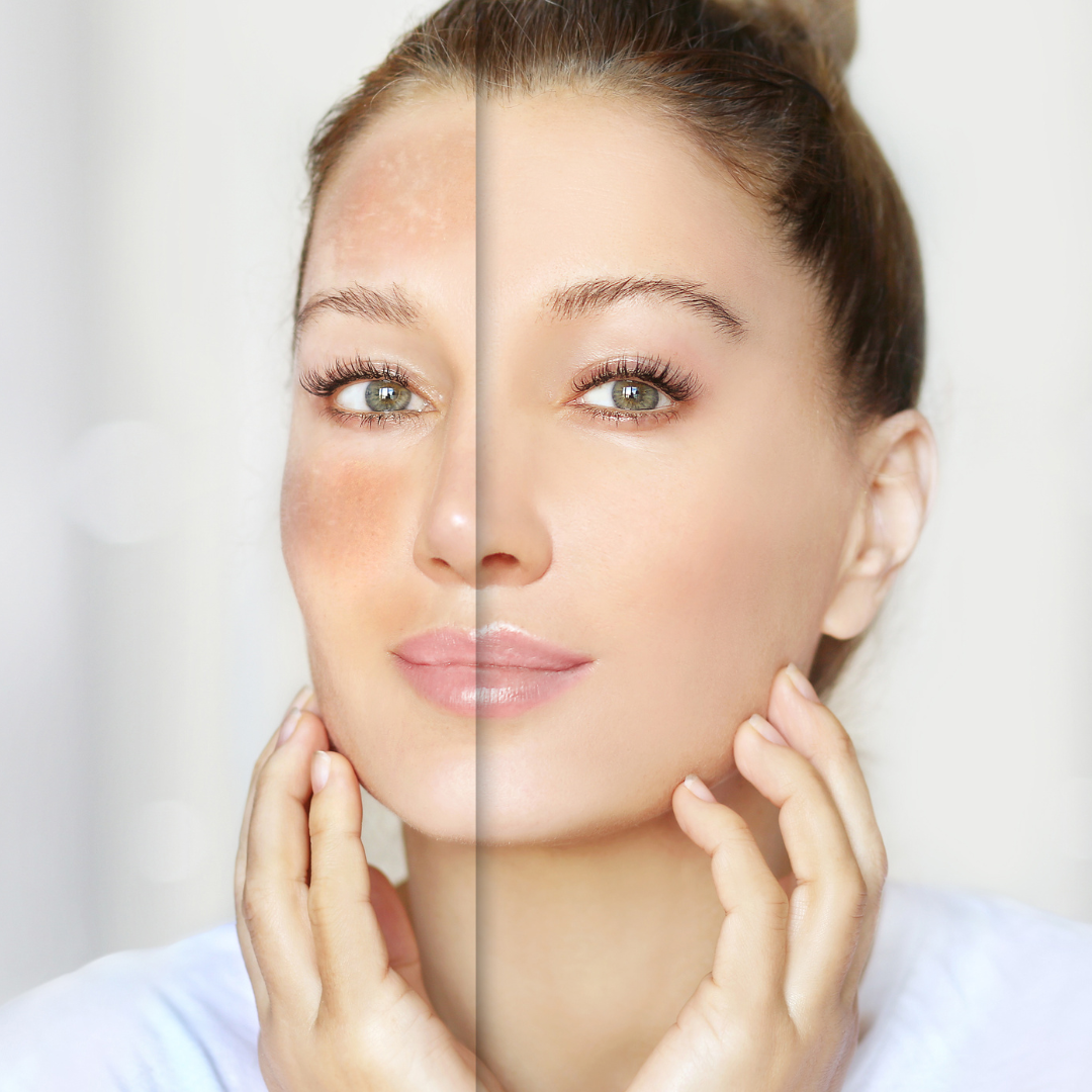 Buy Reborn Cream For Sensitive Area Brightening & Dark Spot Reduction By Wisdom Pharma